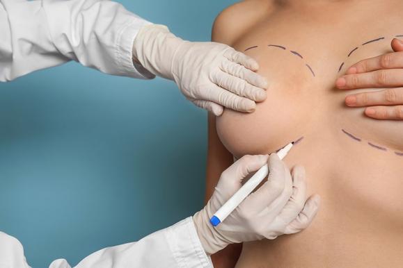 J'ai les seins tombants, quelles solutions de chirurgie esthétique ?, Institut du Sein